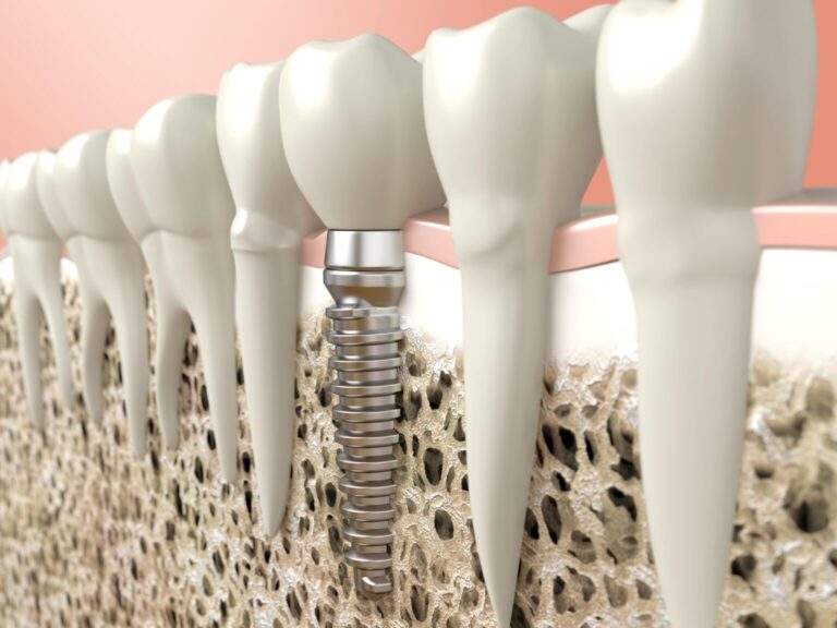 Quality Dental Implants In NW Calgary Dental Implants Near You   Dental Implants Near You 768x576 